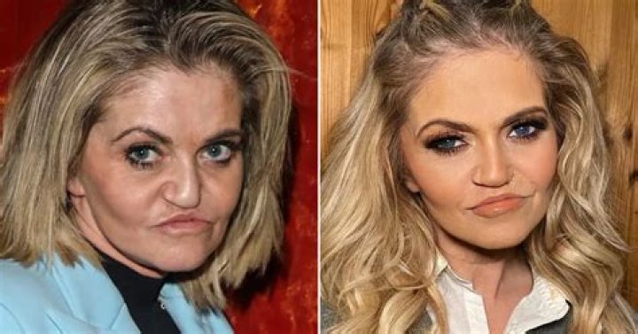 What Happened To Danniella Westbrook Septum? Timeline Of Everything She Has Done On Her Face